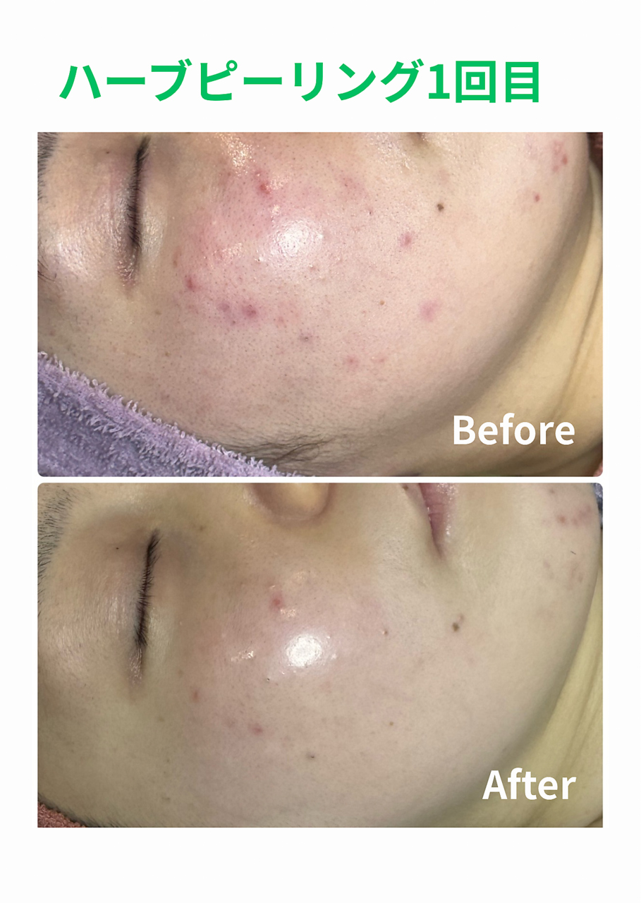 毛穴屋 京都/なめらか透明感肌へ。