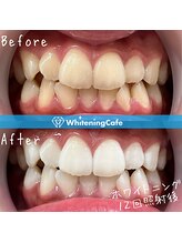 ホワイトニングカフェ 和歌山ガーデンパーク店(WhiteningCafe)/16分×2回照射/6回来店/10代女性