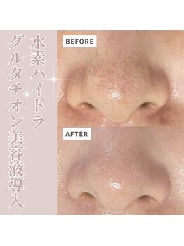 ベル(Belle)の写真/《つるんつるん☆ツヤ肌爆誕！》角栓・ざらつきが気になる方に◎【水素ハイドラフェイシャル】