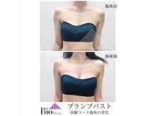 バイオビューティー 神戸本店(Bio Beauty)/プランプバスト　体験コース症例