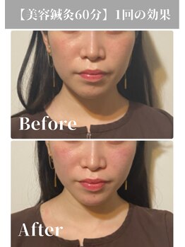 サンクエール 代官山鍼灸院(CINQ AILES)/美容鍼　リフトアップ・くすみ