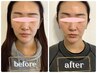 【1ヶ月以内の再来限定☆】フェイスライン&頬/小顔溶解ピストル　