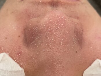 サロン ド リリー(salon de lily)の写真/いま話題の【毛穴クリーンケア】速攻効果で満足度＆人気No.1★諦めていた毛穴の黒ずみ・詰まりはお任せ！