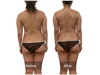 ベンザイ 新潟店(BENZAI)/背中のバスト流れ放題の人