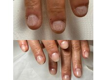 短爪、噛爪、割れやすいなどのトラブル爪に対応した深爪ケア◎