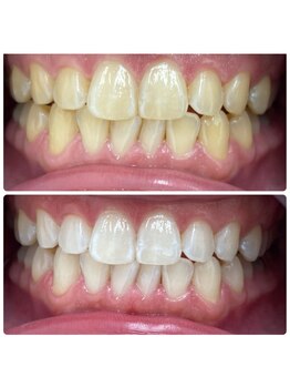 エクシアホワイトニング 日本橋店/人形町ホワイトニング