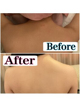 トータルビューティーサロン 凛/全身脱毛