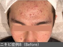 オアシスラグーン(OASIS LAGOON)/ニキビ改善（症例8 before）