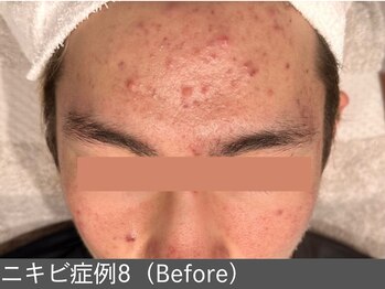 オアシスラグーン(OASIS LAGOON)/ニキビ改善(症例8 before)