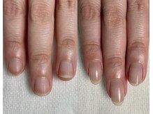 ロイヤル ネイルサロン(Royal nail Saloon)/深爪育成6ヶ月