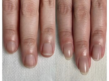 ロイヤル ネイルサロン(Royal nail Saloon)/深爪育成6ヶ月