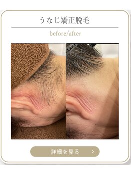 ミース 上野店/うなじの悩みを解決!