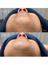 カナウ(KANAU)/ヒゲ脱毛（40代前半男性）