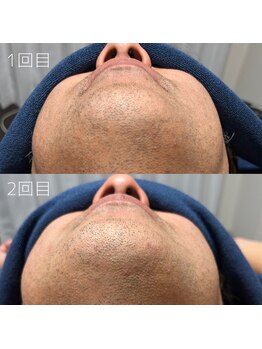 カナウ(KANAU)/ヒゲ脱毛（40代前半男性）