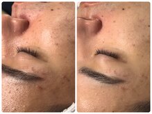 ベルドア(Bell Door)/ニキビケア