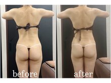 サロン ラズリ(SALON Lazuli)/【1回施術】筋膜リリース痩身