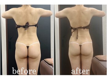 サロン ラズリ(SALON Lazuli)/【1回施術】筋膜リリース痩身