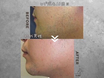 ル シャ/メンズ脱毛/毛穴洗浄/ヘッドスパ