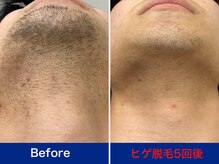 ミスターアンクール 鹿児島(Mr.uncoeur)/ヒゲ脱毛5回後