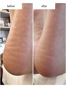 ケアプラス(care plus)/足裏角質ケア