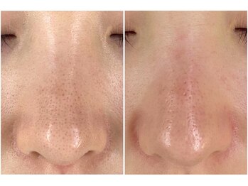 にっこりビューティーの写真/肌悩み第1位!毛穴の黒ずみ・詰まり・開き解消にはハイドラフェイシャルが効果絶大◎ハリ・弾力ぐんとUP!!