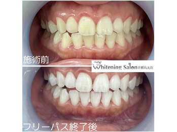 ホワイトニングサロン 京都烏丸店/ホワイトニング施術例