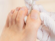 ペディケア 横浜本店/トラブル爪ケア：巻爪ケア