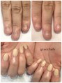 グレースレディ&nbsp;深爪　長さだしフィルイン　ネイル