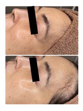 エクラルム(Eclaleum)/BeforeAfter　ララピール