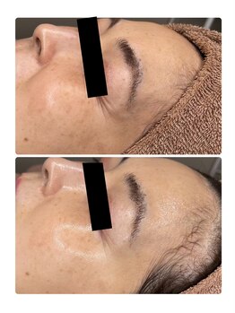 エクラルム(Eclaleum)/BeforeAfter　ララピール