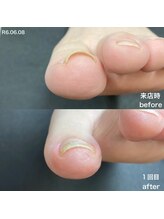 リリ(lili)/巻き爪矯正1回目（左親指）