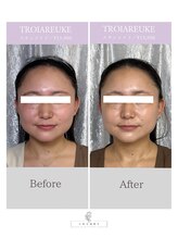 シャムリー(SHAMRY)/TROIAREUKE／スキンメイド