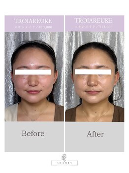 シャムリー(SHAMRY)/TROIAREUKE／スキンメイド