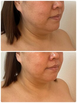 ルミア(LUMIA)/小顔造形ロイヤル