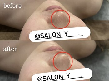 サロンワイアネシス(Salon y ANESIS)/ハーブピーリング１回の変化