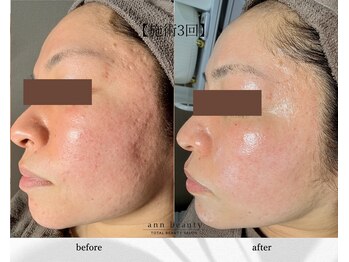 アン ビューティー(ann beauty)の写真/医師監修"乳酸ピーリング"最新韓国肌管理◎ララピールの上位版《ダクトピール》×ヒト幹エクソソーム導入