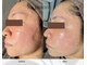 アン ビューティー(ann beauty)の写真/医師監修"乳酸ピーリング"最新韓国肌管理◎ララピールの上位版《ダクトピール》×ヒト幹エクソソーム導入