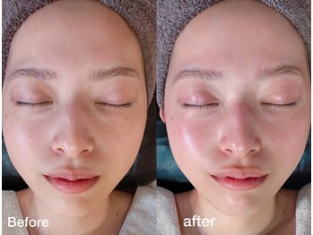 サロンプレーマ(Salon Prema)の写真/感動の肌体験！剥けないハーブピーリングで毛穴レス美肌、憧れの小顔と土台作り◎