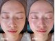 サロンプレーマ(Salon Prema)の写真/感動の肌体験！剥けないハーブピーリングで毛穴レス美肌、憧れの小顔と土台作り◎