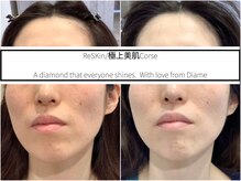ディアメ(Diame)/くすみを改善して美 白 肌をGet!