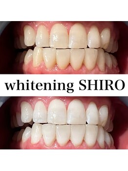 福岡ホワイトニングシロ 天神中洲店(福岡ホワイトニングSHIRO)/【ホワイトニング】before/after