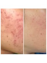 アリュール(Allule)/敏感肌コースにて