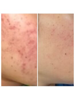 アリュール(Allule)/敏感肌コースにて