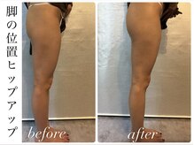 ビノスビューティー(vinos.beauty)/症例写真　ヒップアップ