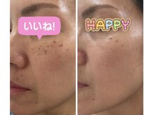 お悩みのシミ改善できる今までにないシミケアが可能、変化を実感