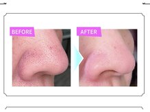 毛穴洗浄で黒ずみ・ザラつきをしっかり落とし、化粧ノリも◎