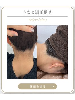 ミース 上野店/手触りも変わる脱毛