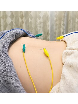 森脇鍼灸整骨院 吹田本院の写真/【鍼灸】慢性的な肩こり、腰痛や頭痛に深層からアプローチ! 通常¥5280→¥3,980 症状の予防にも◎