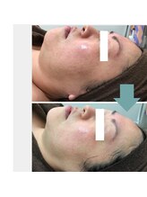 レベンディス(LEVENDIS)/ハーブピーリング×BBL