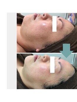 レベンディス(LEVENDIS)/ハーブピーリング×BBL